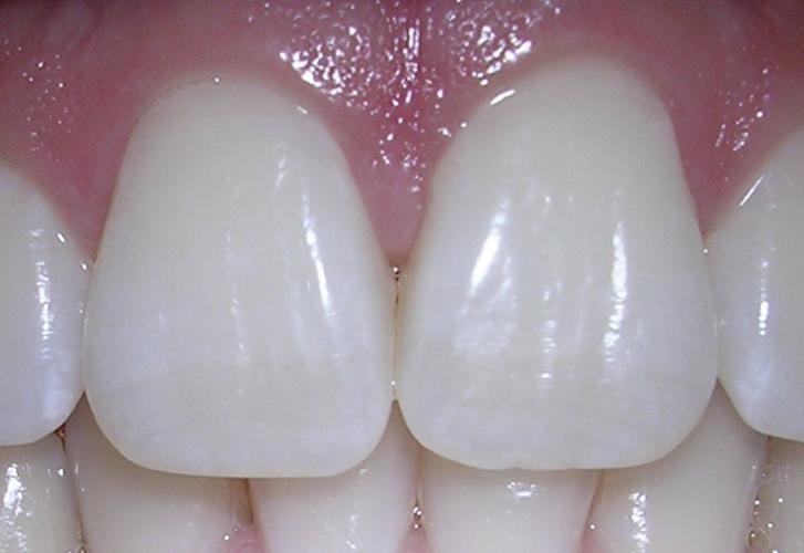 Dent