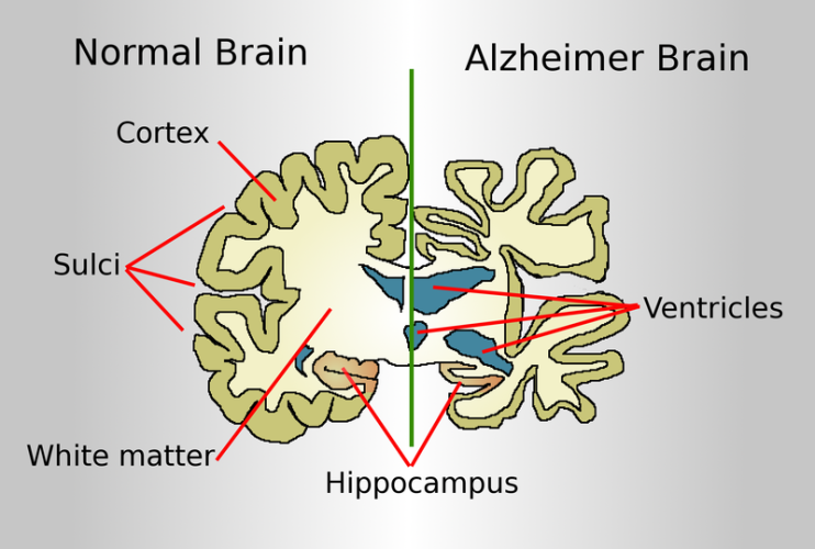 Enfermedad de Alzheimer