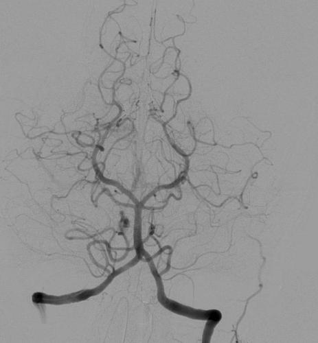 Angiografie