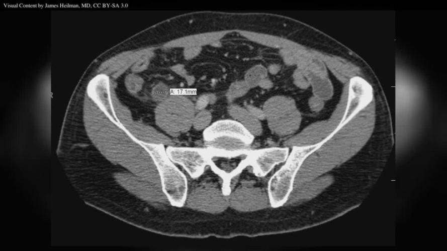 Appendizitis