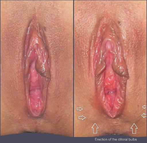 Clitoral erection