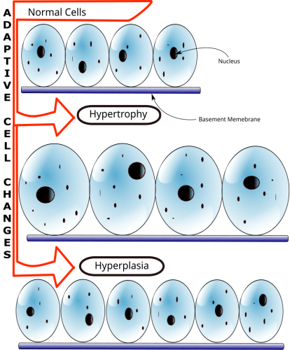 Hypertrophie