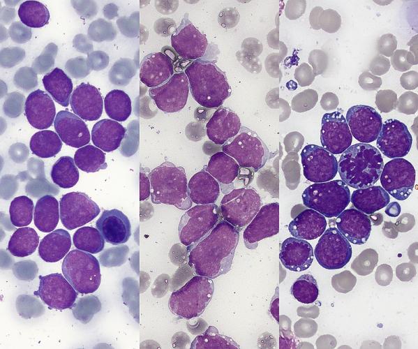 Akute lymphatische Leukämie