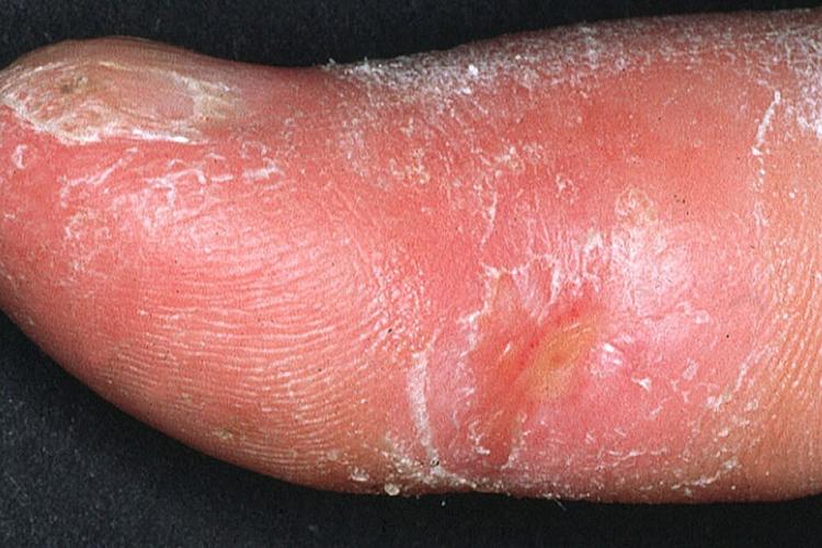 Systemic scleroderma