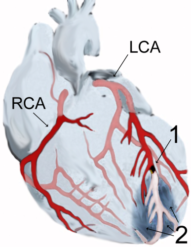 Infarto agudo de miocardio