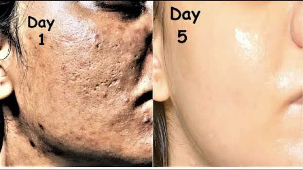 Video En seulement 3 nuits, adieu les taches sur le visage avec cette astuce em português