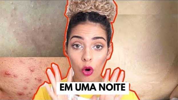 Video COMO ACABAR com ESPINHAS E MANCHAS em UMA NOITE @Faladantas   türkçe