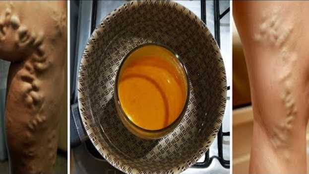 Video Esfregue Isso nas VARIZES e elas vão sumir da Sua Pele em Poucos Dias #ReceitaCaseira   türkçe