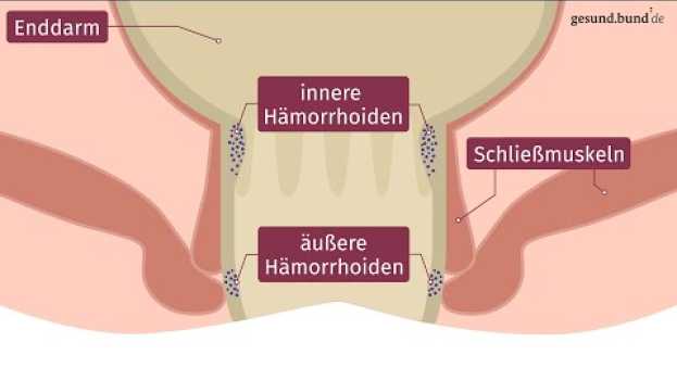 Video Was sind Hämorrhoiden? in English