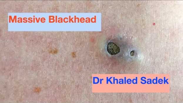 Video Massive 3 year old Blackhead finally comes out. Dr Khaled Sadek. LipomaCyst.com auf Deutsch