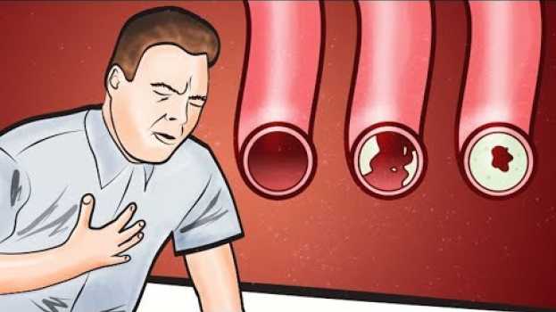 Video Questi alimenti ripuliscono le arterie e possono prevenire un attacco di cuore   türkçe