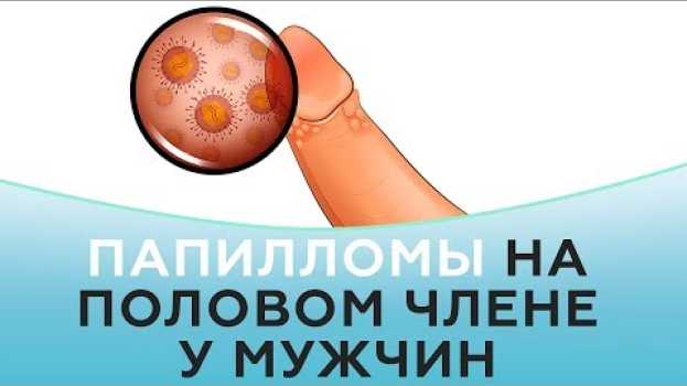 Video Папилломы на половом члене у мужчин [+18] en français