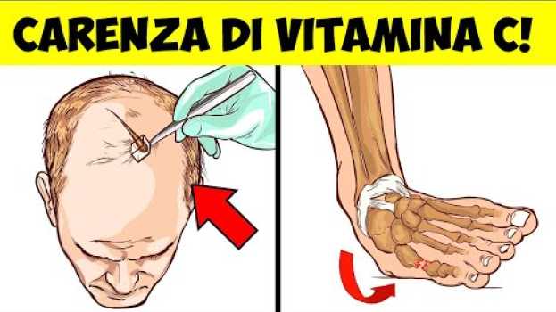 Video I sintomi da carenza di vitamina C che non devono mai essere ignorati in English