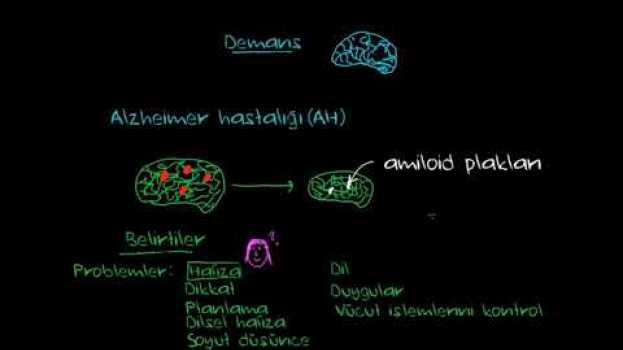 Video Alzheimer Hastalığı ve Korsakoff Sendromu (Psikoloji / Akıl Sağlığı) (Sağlık Bilgisi ve Tıp) su italiano