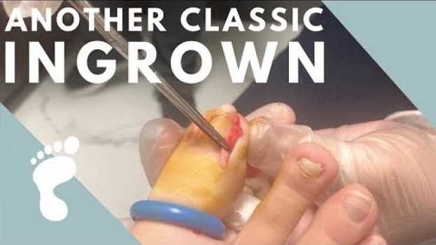 Video You guessed it... ANOTHER INGROWN TOENAIL! po polsku