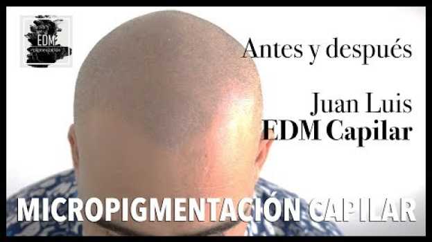 Видео Antes y después de la migmentación capilar - Los resultados reales de Juan Luis на русском