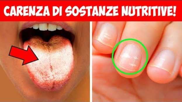 Video I 9 segni di carenza di sostanze nutritive che non devono essere ignorati auf Deutsch