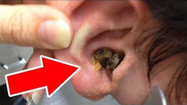 Video Con Questo Trucco Casalingo, Puoi Dire Addio Al Cerume In Eccesso In 10 Minuti po polsku