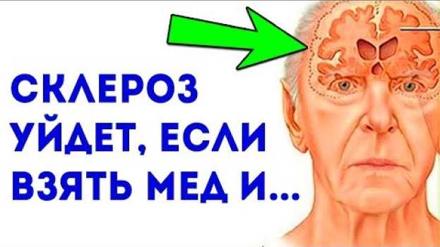 Video Уникальное древнее средство от рассеянного склероза / Чтобы не получить склероз, рекомендуется... em português