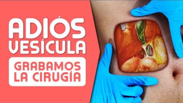 Video LA VESÍCULA ¿Cuándo es Mejor OPERAR? Síntomas, Cálculos, Pólipos y Cáncer su italiano