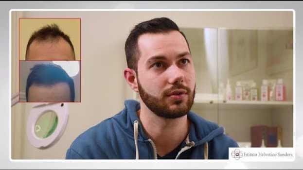 Video Trapianto Capelli fue in Italia: i risultati di Davide dopo alcuni mesi en español