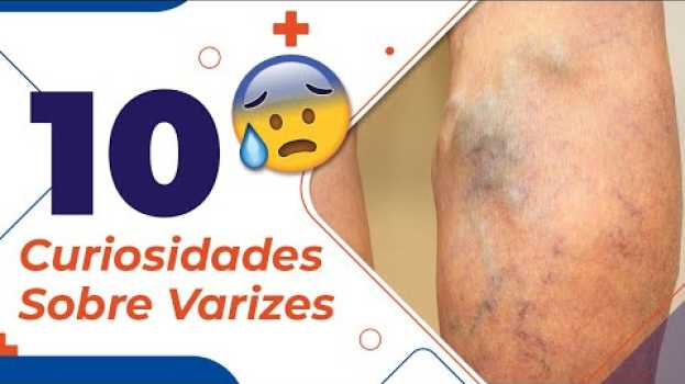 Video 10 Curiosidades sobre Varizes. Não perca! en français