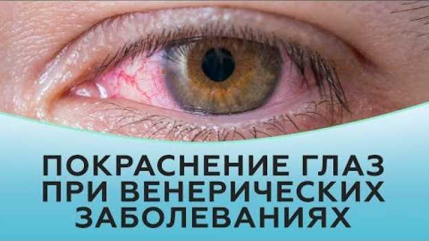 Video Покраснение глаз при венерических заболеваниях su italiano