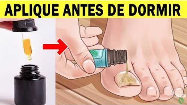 Video 👣REMOVE FUNGOS. SÓ 3 Gotas Deste Óleo Para Eliminar os FUNGOS DAS UNHAS em Poucos Dias en français