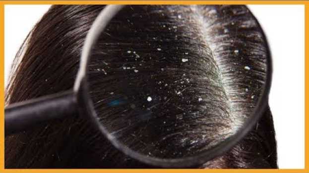 Video ♡ Come ELIMINARE la FORFORA dai capelli ♡ in English
