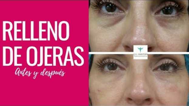 Видео Rellenos Faciales Para Ojeras en Mujeres de 40 años y más | Cuarentonas y Felices на русском