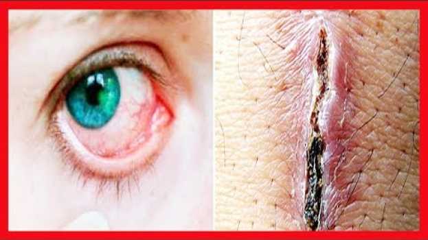 Video Sintomas da Diabetes ➨ Você Também Sente Isso? MUITO CUIDADO!!! po polsku