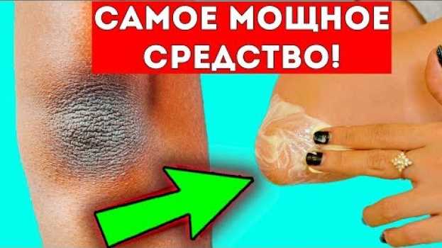 Video 15 мин и тёмные пятна на локтях исчезнут! Красивая кожа на руках, локтях... en français