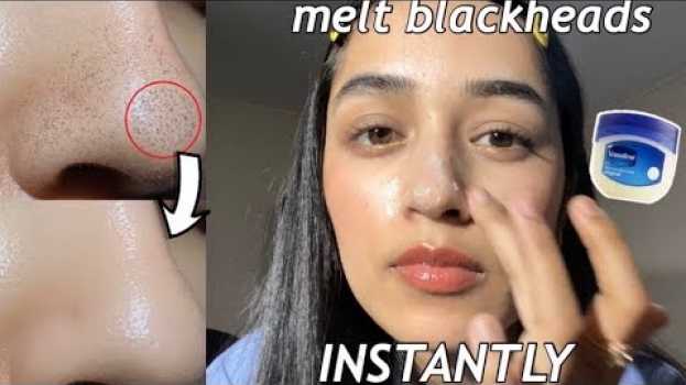 Video I removed my blackheads INSTANTLY w/ VASELINE + OIL! | How to get rid of blackheads auf Deutsch