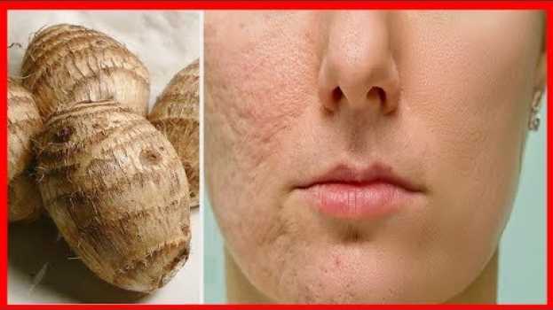 Video REMOVA 10 ANOS DE RUGAS, CICATRIZ E MANCHAS NA PELE COM ISSO...   türkçe
