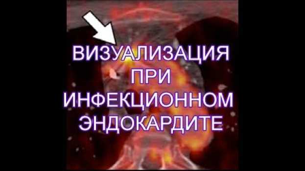 Video Мультимодальная визуализация при инфекционном эндокардите in English