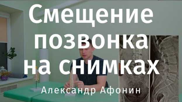 Video Смещение позвонков на рентгеновских снимках, чтобы вы могли оценить состояние позвоночника auf Deutsch