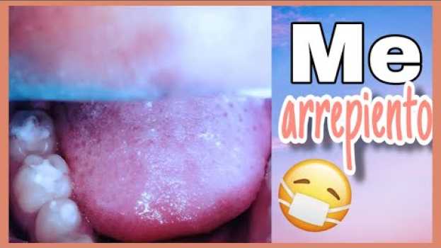 Видео Mira Esto Antes de Quitarte Las Caries | caries antes y después на русском