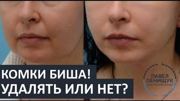 Video Комки Биша: УДАЛЯТЬ или НЕТ? | Вопросы и ответы en español