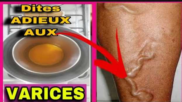 Video Avec cette astuce naturelle vos varices disparitions très rapidement et sans douleur auf Deutsch
