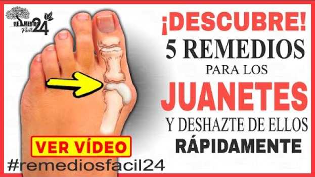 Video Descubre los 5 Remedios Caseros para los Juanetes y Deshazte de Ellos | Juanetes en los Pies   türkçe