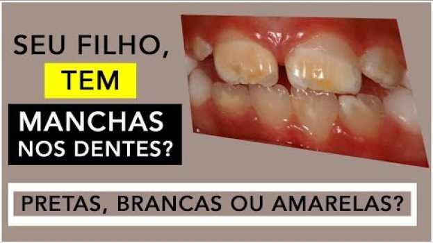 Video Manchas nos dentes pode ser cárie? | Odontopediatria - Dentalkids in English