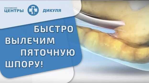 Video 👣 Что такое пяточная шпора и как ее лечить. Пяточная шпора как лечить. Дикуль. 12+ em português