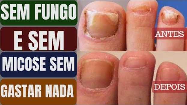 Video Diga Adeus a Micose nas Unhas com Este Remédio Caseiro -  Você Vai se SURPREENDER com o Resultado!💅 in English