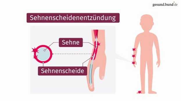 Video Was ist eine Sehnenscheidenentzündung?   türkçe
