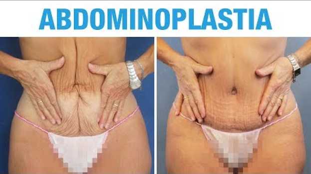 Video Abdominoplastia después del Embarazo - Resultados - Clínicas Diego de León auf Deutsch