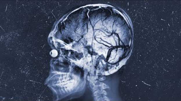 Video A Bitcoin Miner Heatstroked In His Sleep. This Is What Happened To His Organs. em português