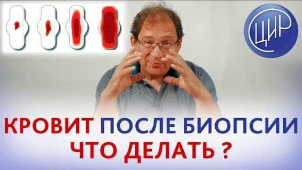 Video КРОВИТ ПОСЛЕ БИОПСИИ. Что делать? Последствия биопсии шейки матки при подозрении на миому в 71 год. po polsku