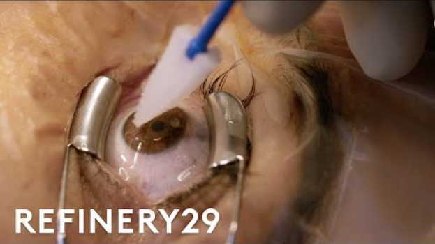 Video What Getting Laser Eye Surgery Is Really Like | Macro Beauty | Refinery29   türkçe