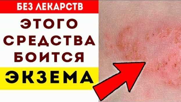Video Вот как просто избавиться от экземы! Лучшие рецепты лечения экземы в домашних... Как лечить экзему po polsku