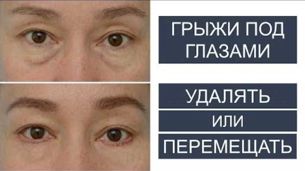 Video Грыжи под глазами: УДАЛЯТЬ или ПЕРЕМЕЩАТЬ? po polsku